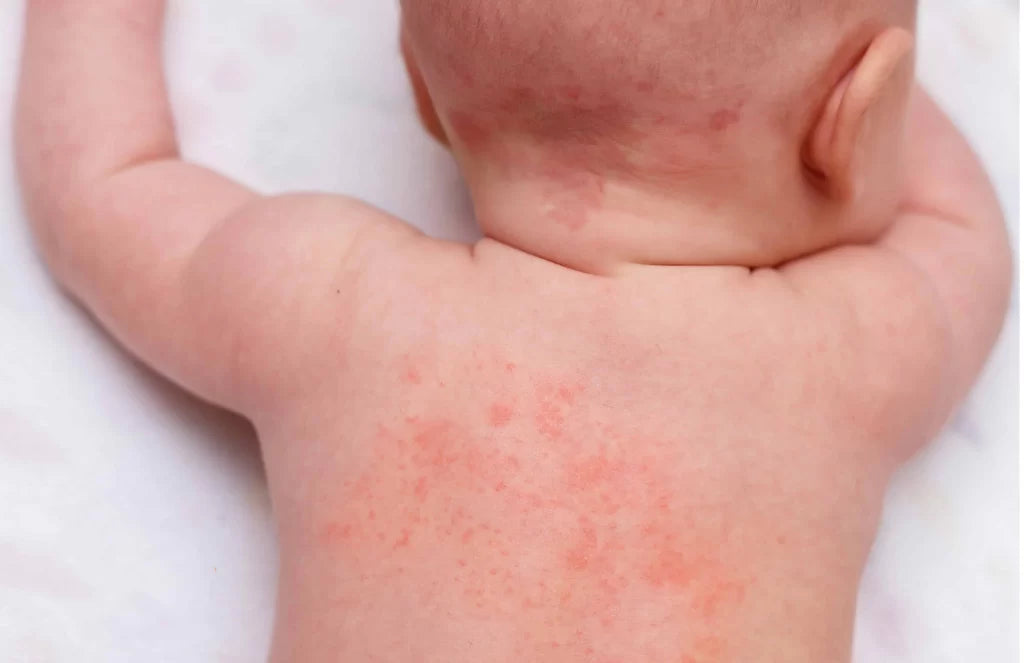 Common Newborn Skin Conditions In Babies Shushu Babies